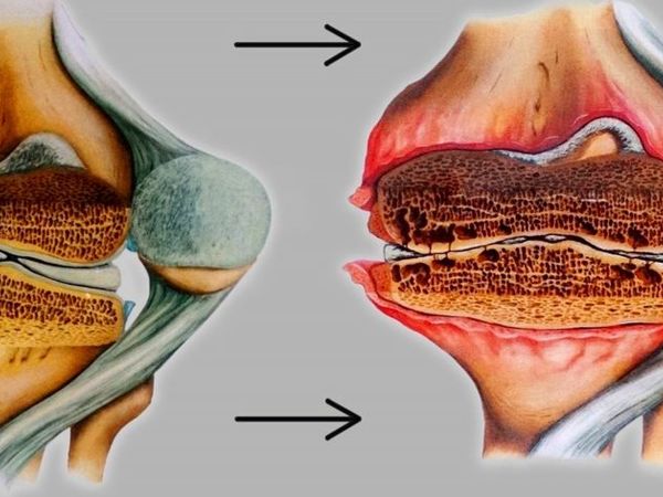 Боль в суставах| Справочник симптомов КЛРЦ