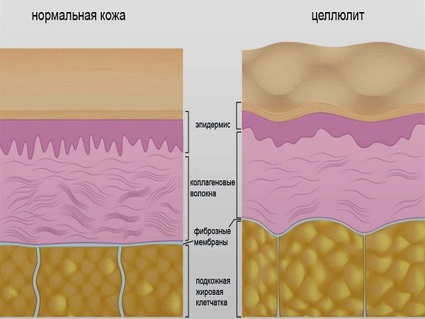Целлюлит | Ярмарка Мастеров - ручная работа, handmade