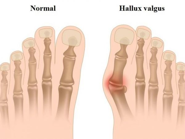 Hallux valgus | Ярмарка Мастеров - ручная работа, handmade