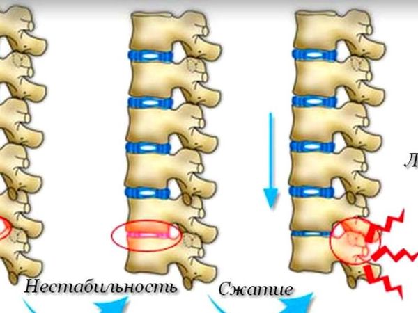 Люмбалгия поясничного отдела - MedClinic